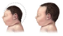 Zika infection, Zika virus, microcephaly, outbreak, sex, pregnancy, mosquito, flu, symptoms, prevention, Rajasthan, Jaipur, Guillain-Barré syndrome